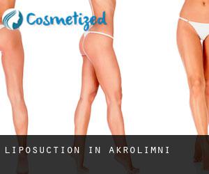 Liposuction in Akrolímni