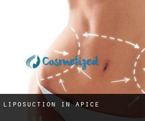 Liposuction in Apice