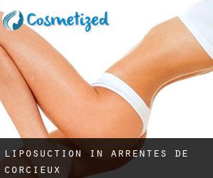 Liposuction in Arrentès-de-Corcieux
