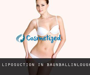 Liposuction in Baunballinlough