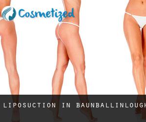 Liposuction in Baunballinlough