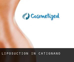 Liposuction in Catignano