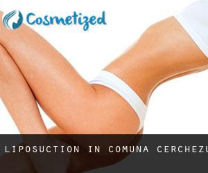 Liposuction in Comuna Cerchezu