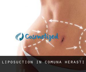 Liposuction in Comuna Herăşti