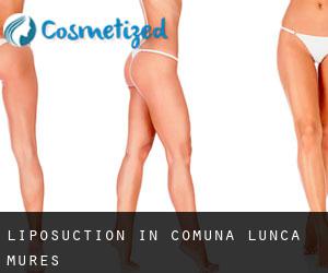 Liposuction in Comuna Lunca (Mureş)