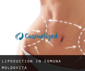 Liposuction in Comuna Moldoviţa