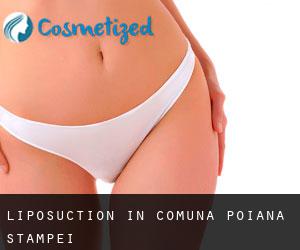 Liposuction in Comuna Poiana Stampei