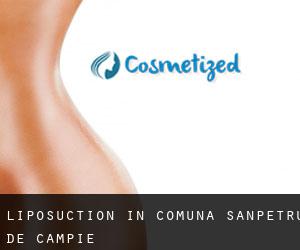 Liposuction in Comuna Sânpetru de Câmpie