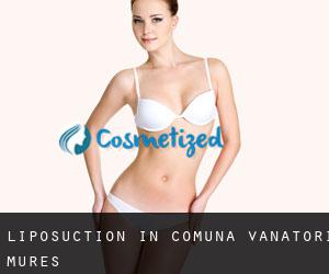 Liposuction in Comuna Vânători (Mureş)