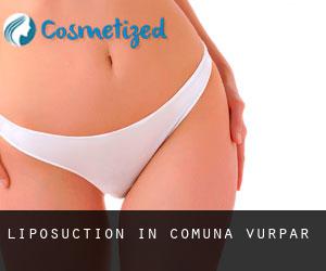 Liposuction in Comuna Vurpăr