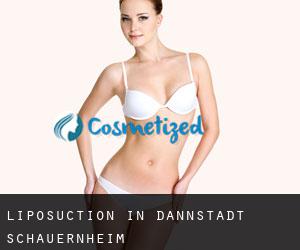 Liposuction in Dannstadt-Schauernheim