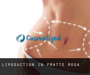 Liposuction in Fratte Rosa