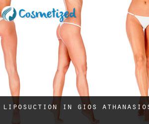 Liposuction in Ágios Athanásios