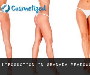 Liposuction in Granada Meadows