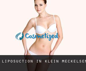Liposuction in Klein Meckelsen