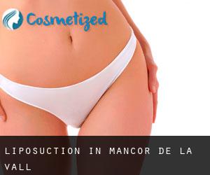 Liposuction in Mancor de la Vall