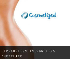 Liposuction in Obshtina Chepelare