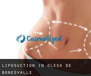 Liposuction in Olesa de Bonesvalls