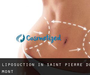Liposuction in Saint-Pierre-du-Mont