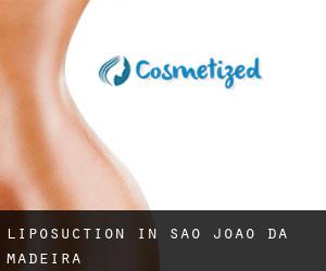 Liposuction in São João da Madeira