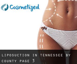 Liposuction in Tennessee by County - page 3