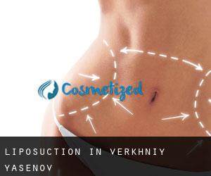 Liposuction in Verkhniy Yasenov