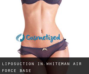 Liposuction in Whiteman Air Force Base