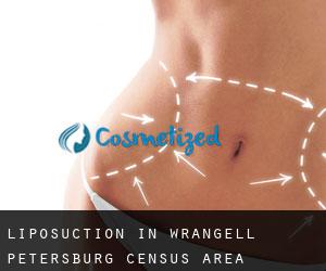 Liposuction in Wrangell-Petersburg Census Area