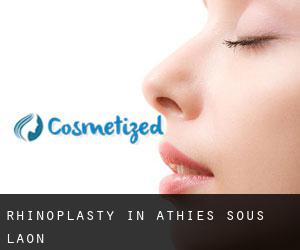 Rhinoplasty in Athies-sous-Laon