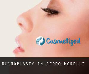 Rhinoplasty in Ceppo Morelli