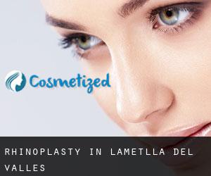 Rhinoplasty in L'Ametlla del Vallès