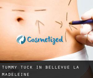 Tummy Tuck in Bellevue - La Madeleine