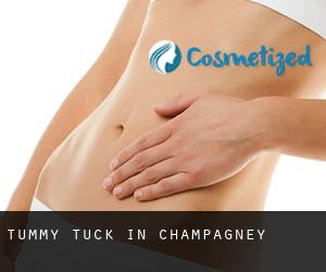 Tummy Tuck in Champagney