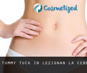 Tummy Tuck in Lézignan-la-Cèbe