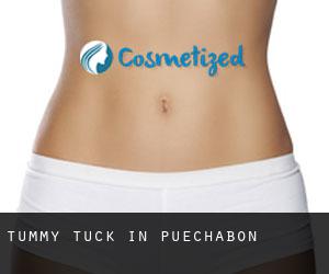 Tummy Tuck in Puéchabon